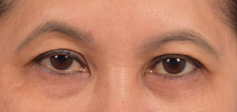 Blepharoplasty Before and After | Cheng Plastic Surgery