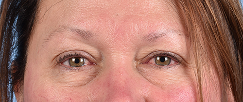 Blepharoplasty Before and After | Cheng Plastic Surgery