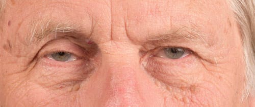 Blepharoplasty Before and After | Cheng Plastic Surgery