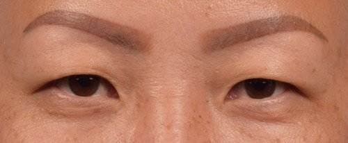 Blepharoplasty Before and After | Cheng Plastic Surgery