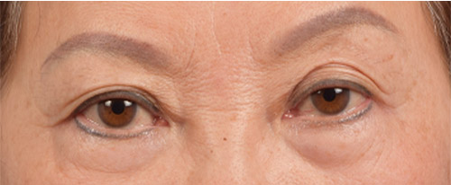 Blepharoplasty Before and After | Cheng Plastic Surgery