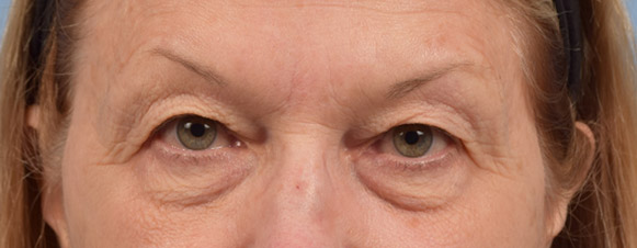 Blepharoplasty Before and After | Cheng Plastic Surgery