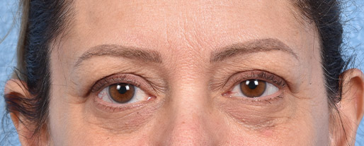Blepharoplasty Before and After | Cheng Plastic Surgery