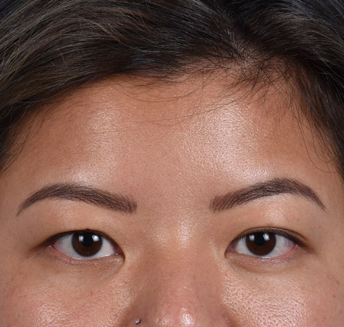 Blepharoplasty Before and After | Cheng Plastic Surgery