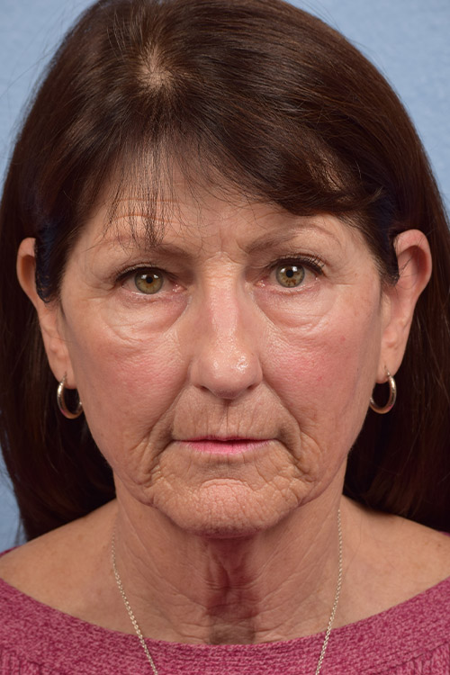 Chemical Peel Before and After | Cheng Plastic Surgery