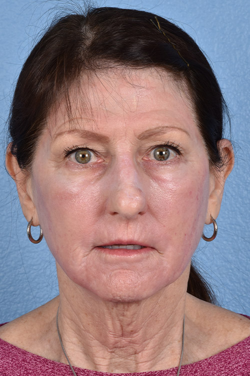 Chemical Peel Before and After | Cheng Plastic Surgery