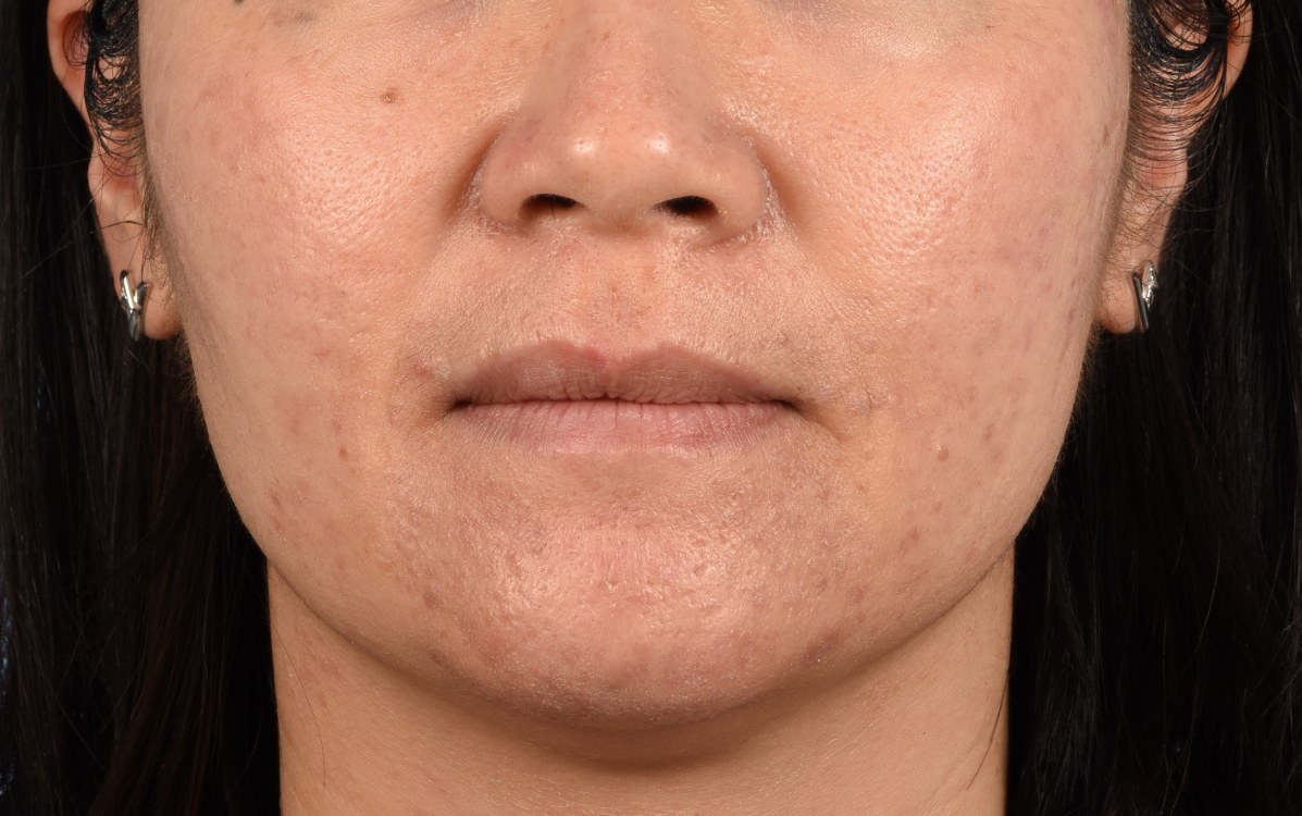 Chemical Peel Before and After | Cheng Plastic Surgery