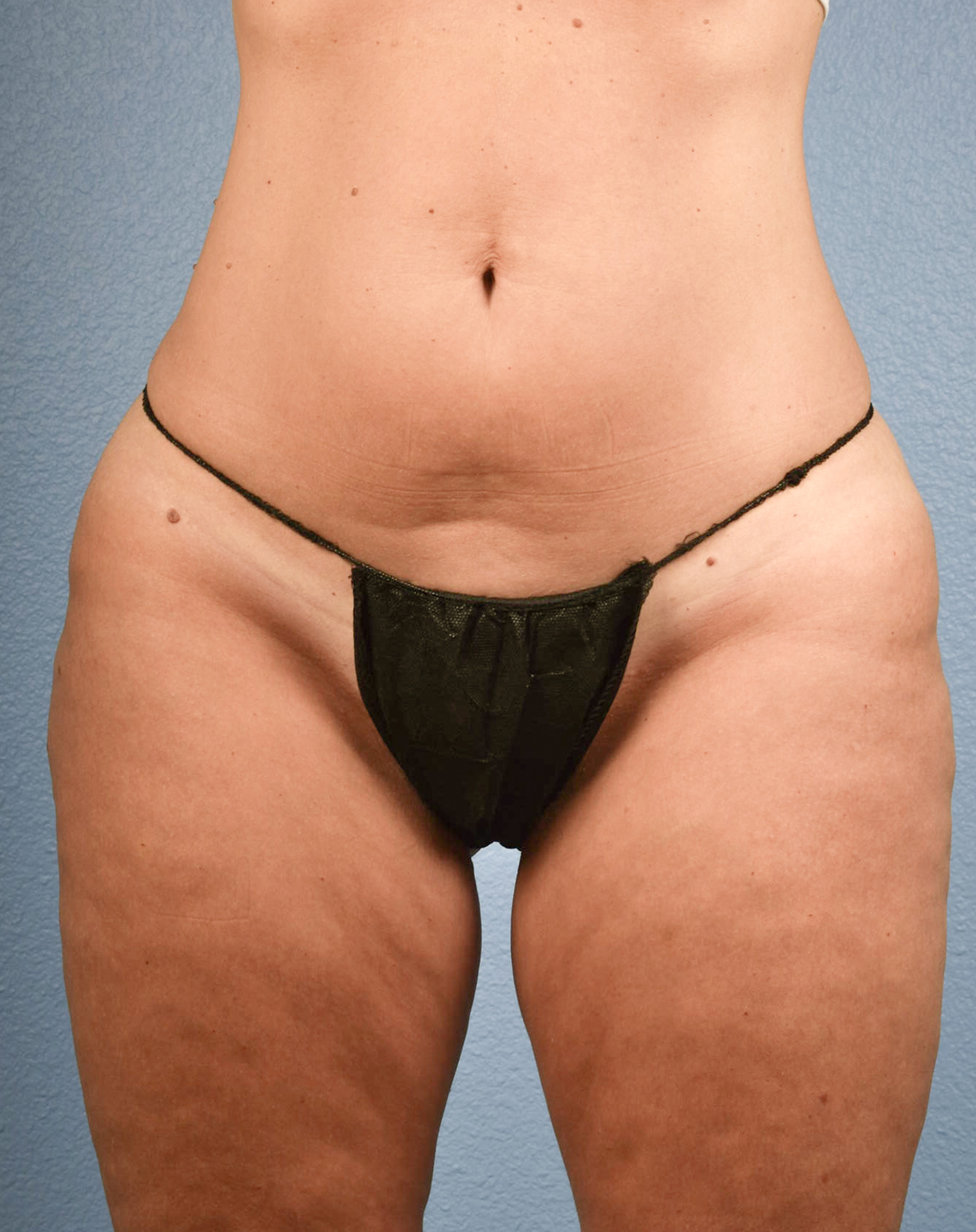 Coolsculpting Before and After | Cheng Plastic Surgery