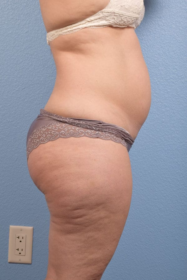 Coolsculpting Before and After | Cheng Plastic Surgery