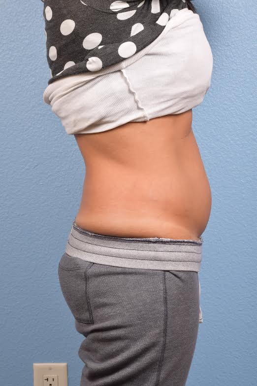 Coolsculpting Before and After | Cheng Plastic Surgery