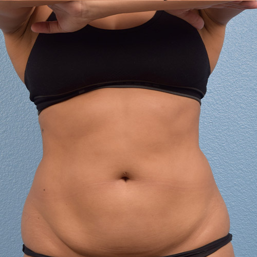 Coolsculpting Before and After | Cheng Plastic Surgery