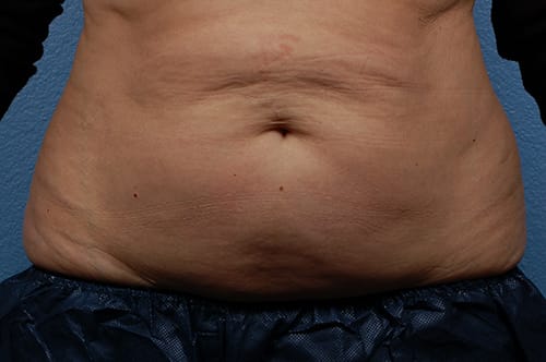 Coolsculpting Before and After | Cheng Plastic Surgery