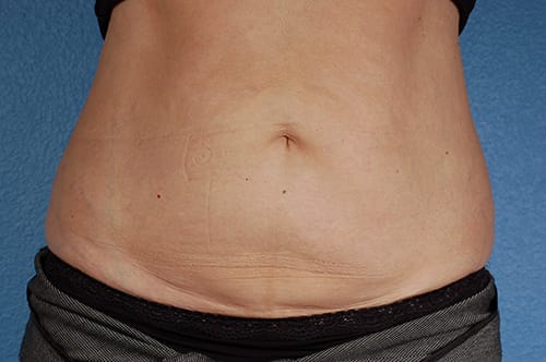 Coolsculpting Before and After | Cheng Plastic Surgery