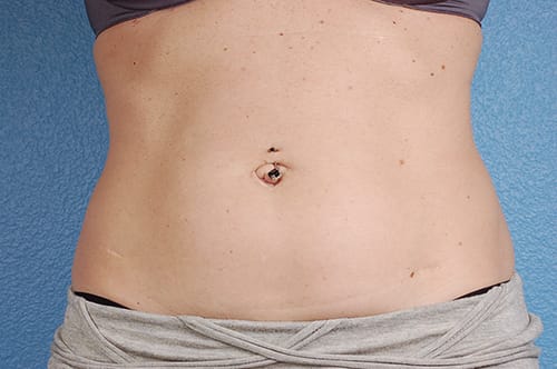 Coolsculpting Before and After | Cheng Plastic Surgery