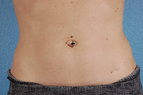 Coolsculpting Before and After | Cheng Plastic Surgery