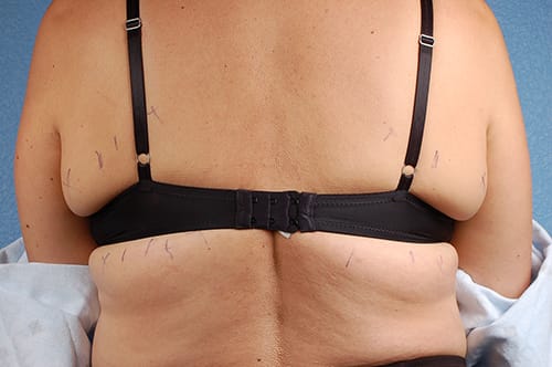 Coolsculpting Before and After | Cheng Plastic Surgery