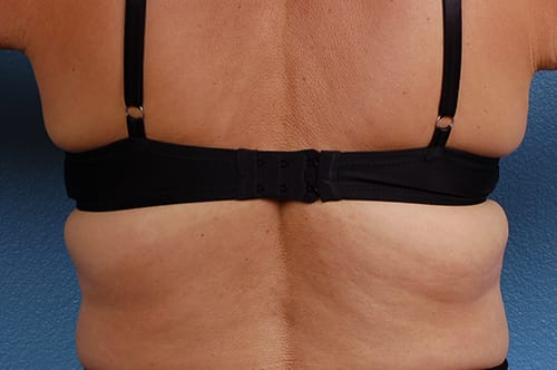 Coolsculpting Before and After | Cheng Plastic Surgery