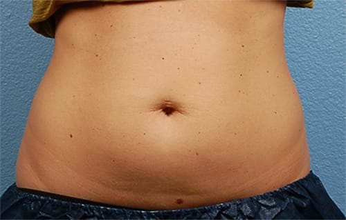 Coolsculpting Before and After | Cheng Plastic Surgery