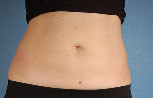 Coolsculpting Before and After | Cheng Plastic Surgery