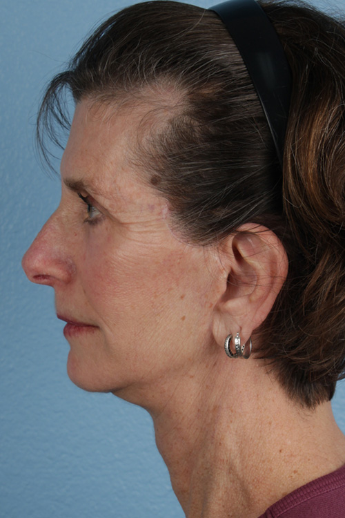 Facelift Before and After | Cheng Plastic Surgery