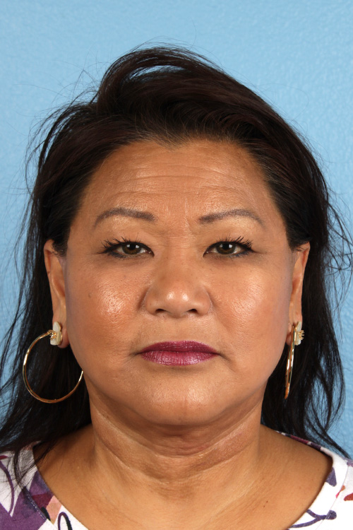 Facelift Before and After | Cheng Plastic Surgery