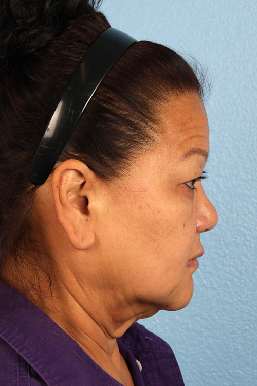 Facelift Before and After | Cheng Plastic Surgery
