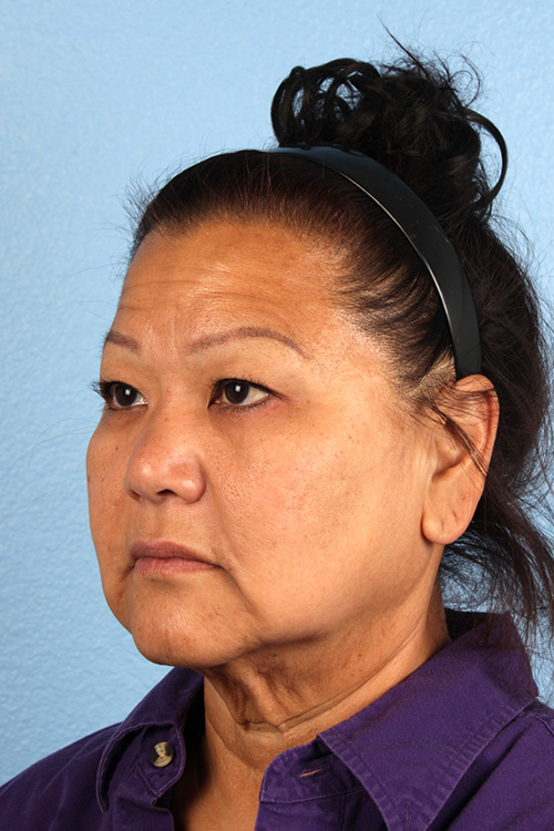 Facelift Before and After | Cheng Plastic Surgery