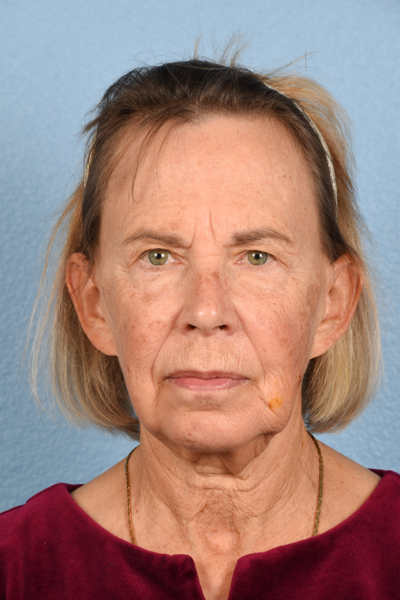 Facelift Before and After | Cheng Plastic Surgery