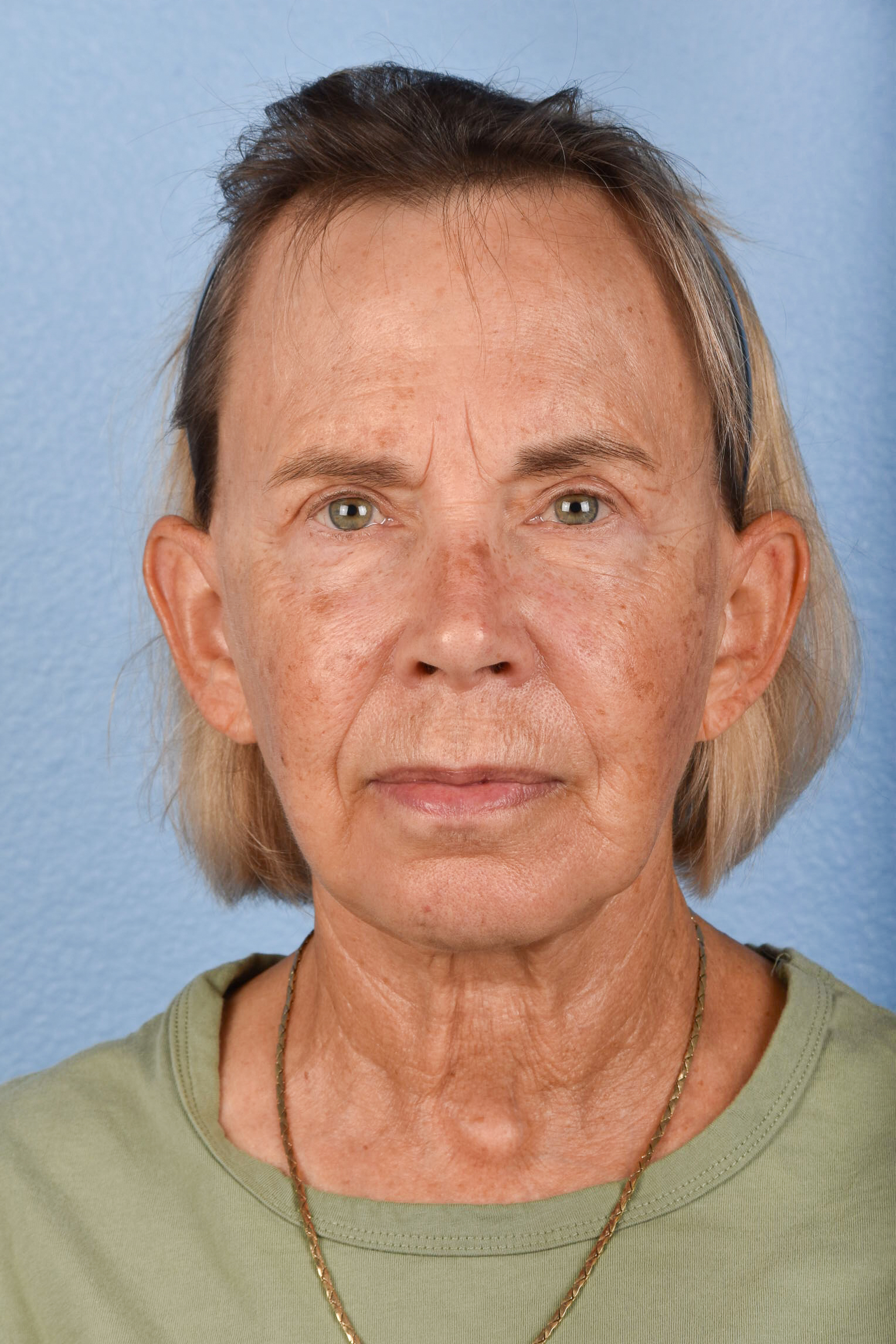 Facelift Before and After | Cheng Plastic Surgery