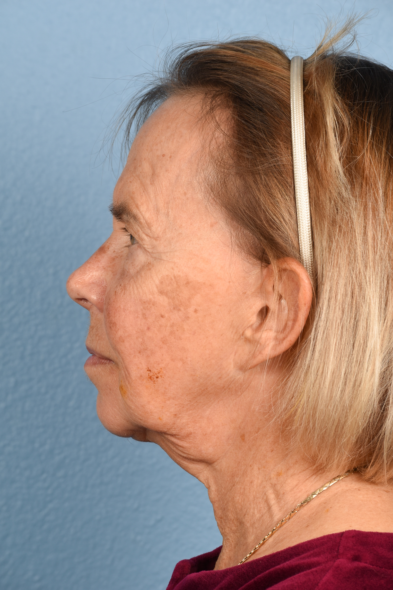 Facelift Before and After | Cheng Plastic Surgery
