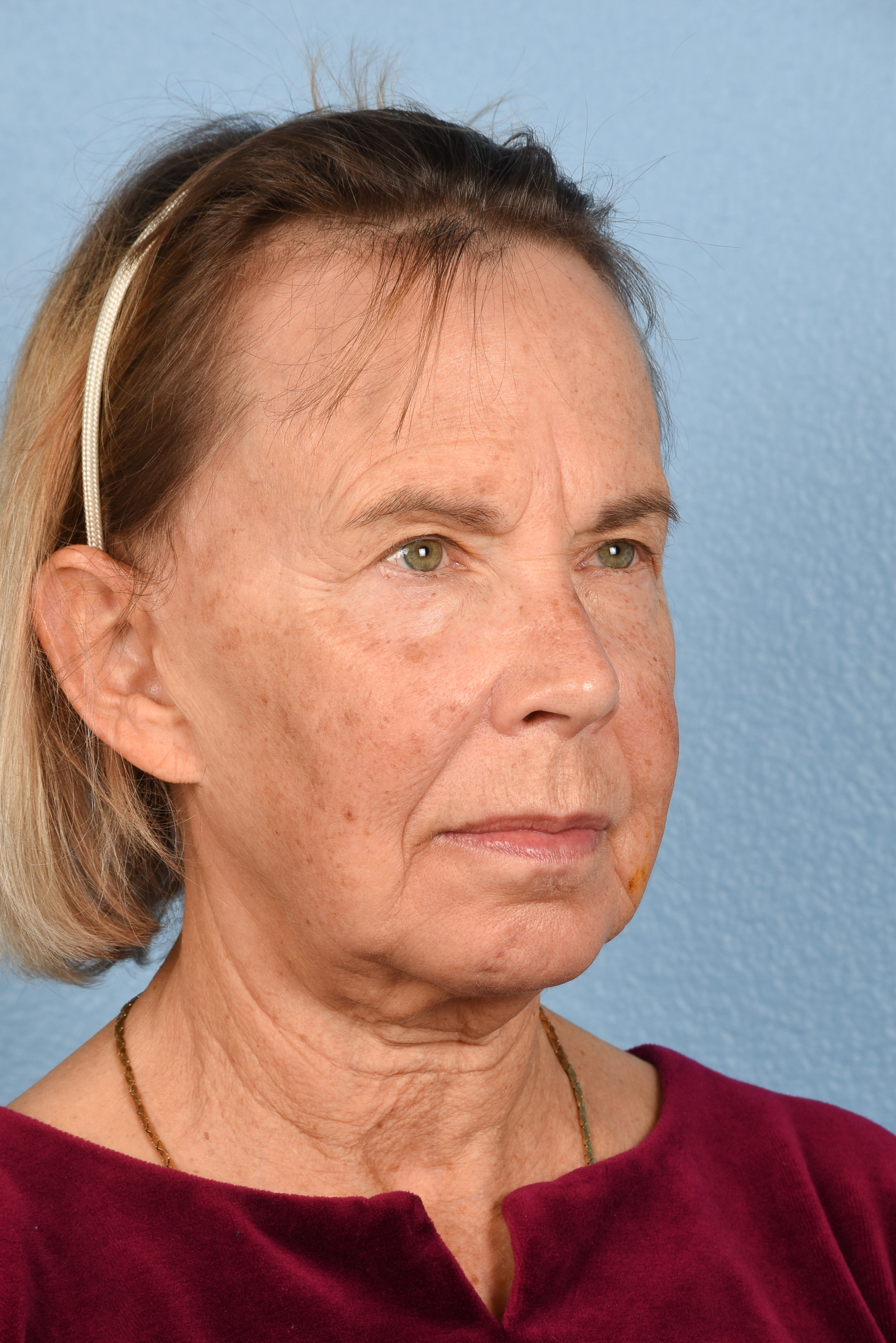 Facelift Before and After | Cheng Plastic Surgery