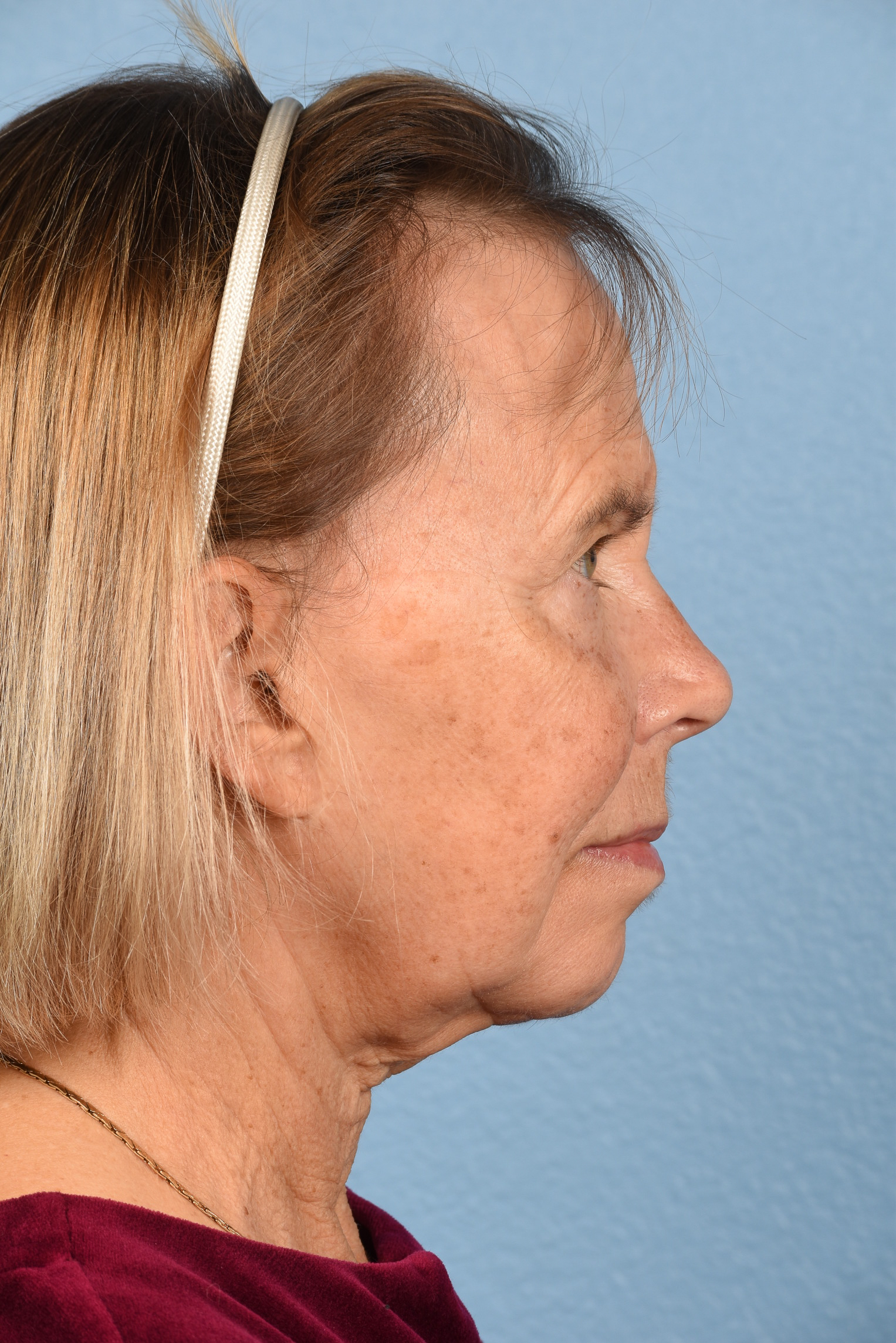 Facelift Before and After | Cheng Plastic Surgery