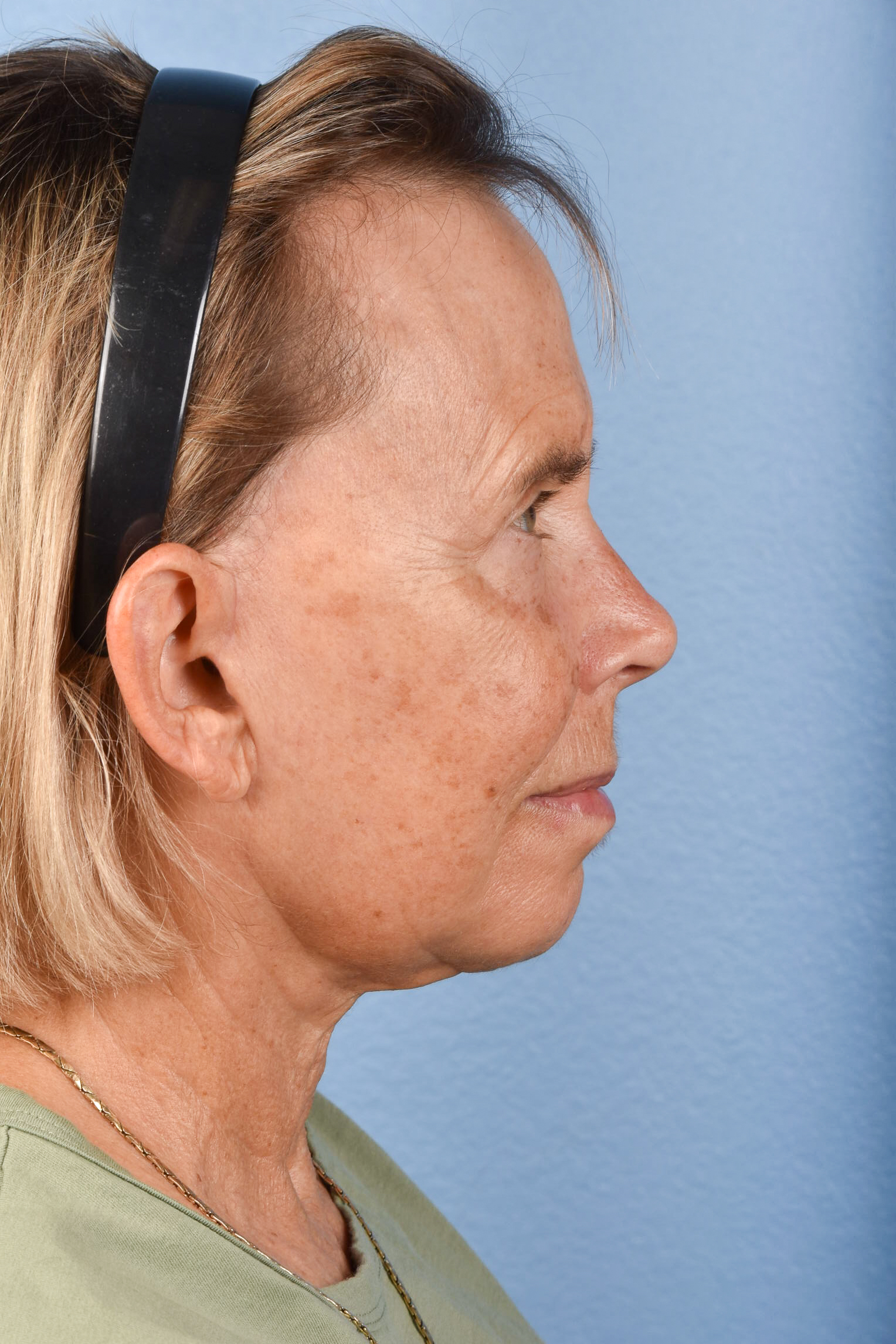 Facelift Before and After | Cheng Plastic Surgery