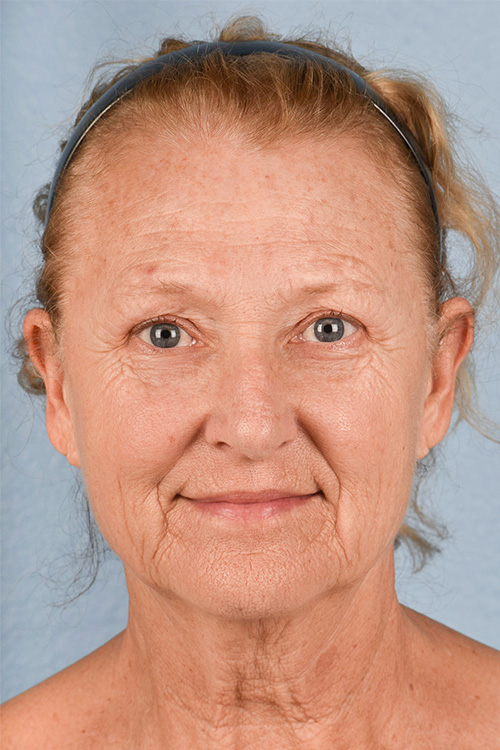 Facelift Before and After | Cheng Plastic Surgery