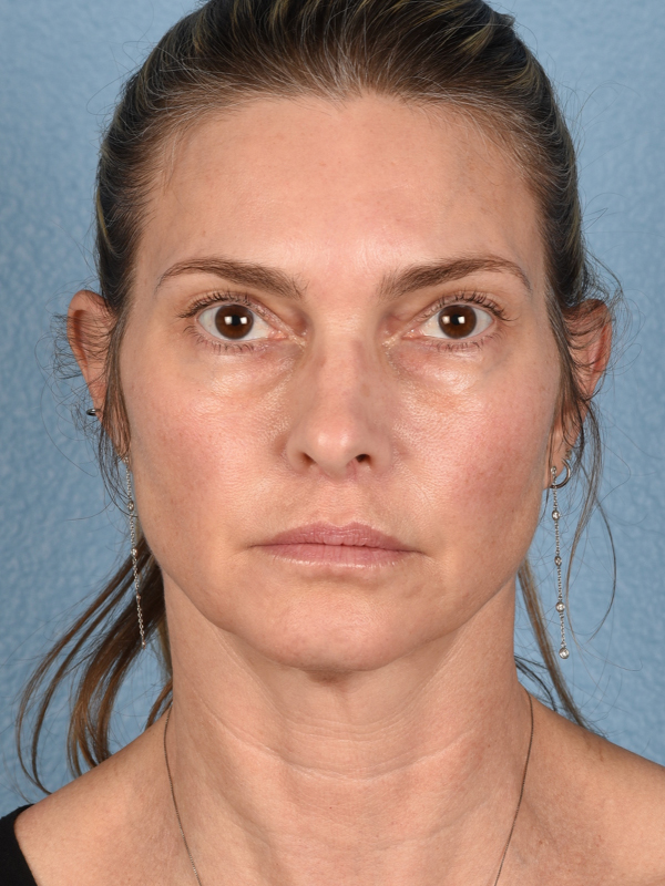 Facelift Before and After | Cheng Plastic Surgery