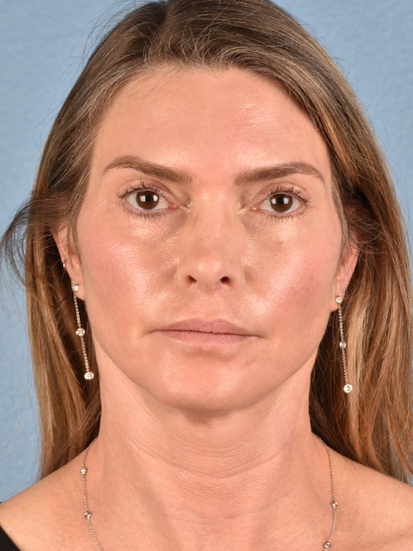 Facelift Before and After | Cheng Plastic Surgery