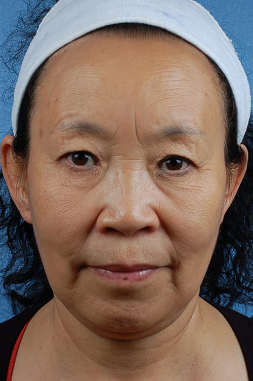 Facelift Before and After | Cheng Plastic Surgery