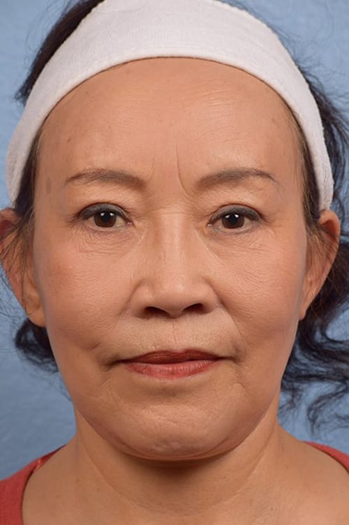Facelift Before and After | Cheng Plastic Surgery