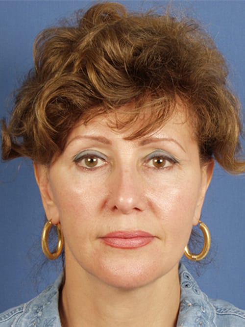 Facelift Before and After | Cheng Plastic Surgery