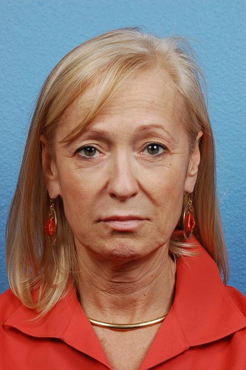 Facelift Before and After | Cheng Plastic Surgery