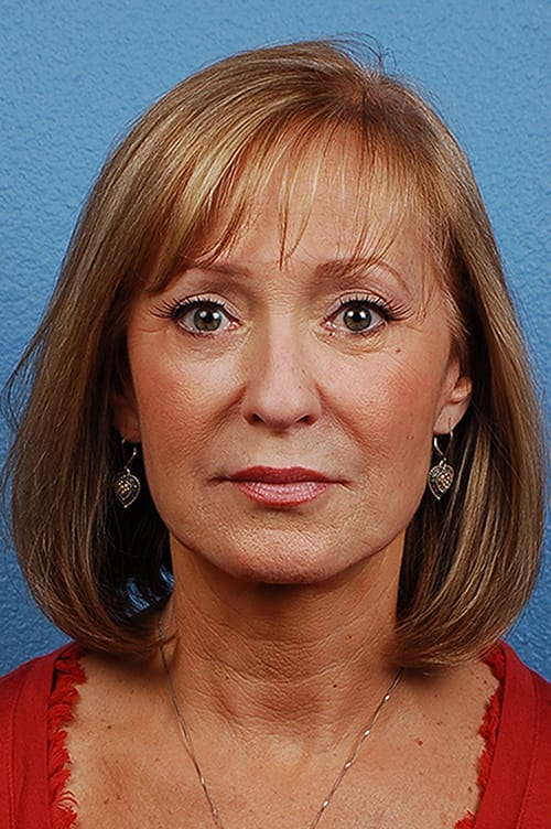 Facelift Before and After | Cheng Plastic Surgery
