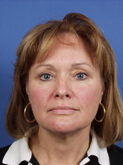 Facelift Before and After | Cheng Plastic Surgery