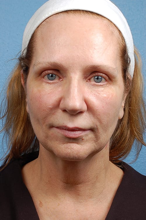 Facelift Before and After | Cheng Plastic Surgery