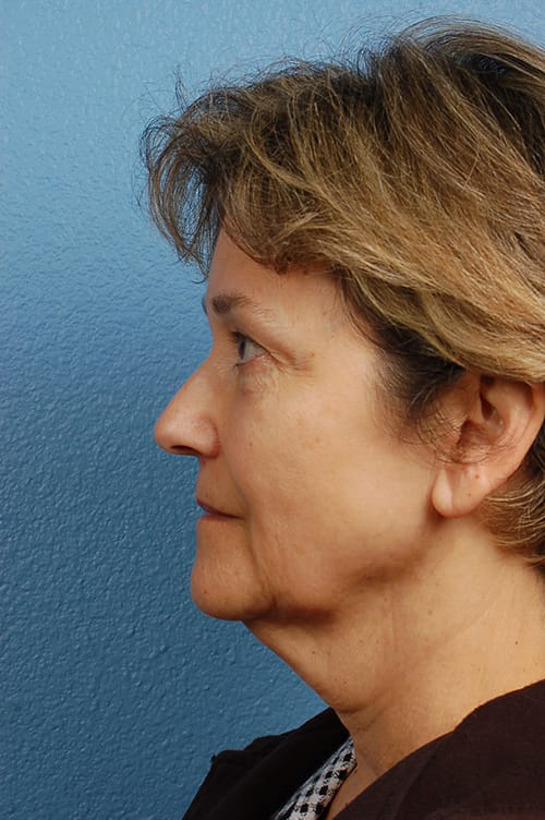 Facelift Before and After | Cheng Plastic Surgery