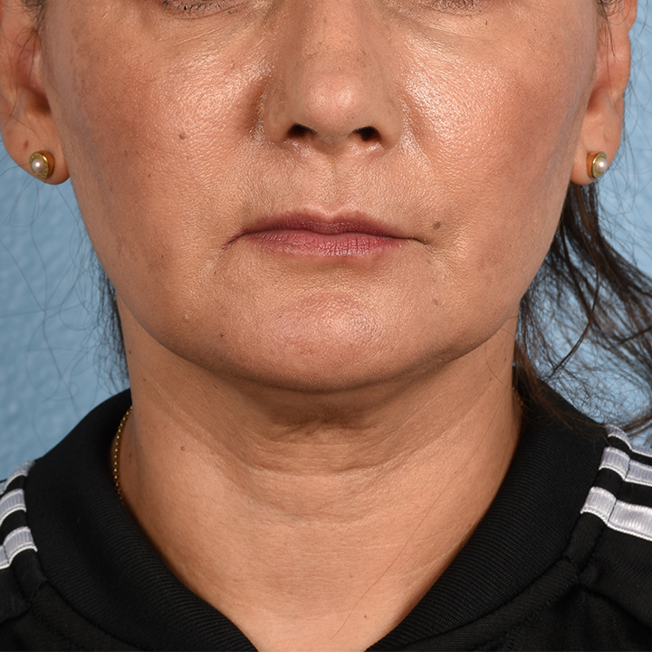 Facelift Before and After | Cheng Plastic Surgery