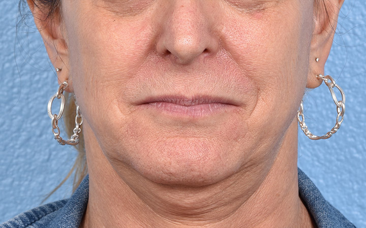 Facelift Before and After | Cheng Plastic Surgery