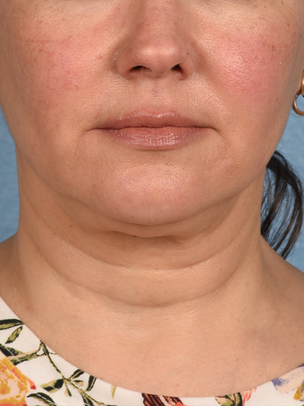 Facelift Before and After | Cheng Plastic Surgery
