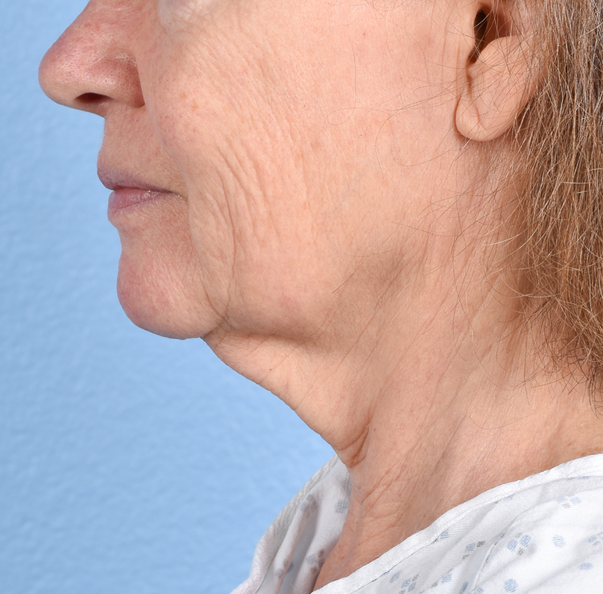 Facelift Before and After | Cheng Plastic Surgery