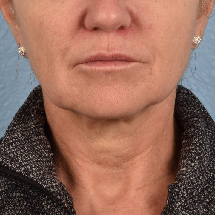 Facelift Before and After | Cheng Plastic Surgery