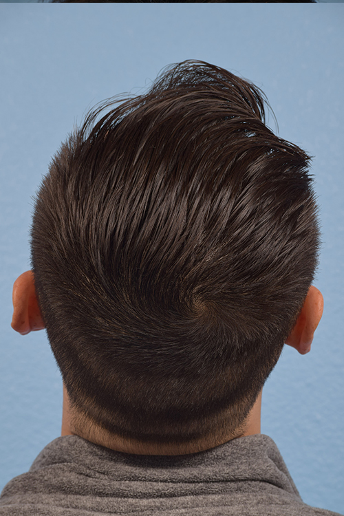 Hair Transplant With Neograft Before and After | Cheng Plastic Surgery